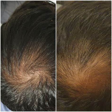 دارو آمیلا داروی آمیلا دارو امیلا