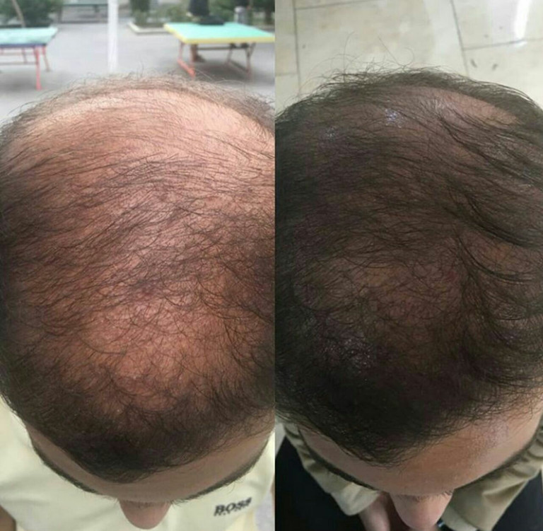 پک آمیلا دارو آمیلا محصول امیلا تقویت مو امیلا رویش مو امیلا